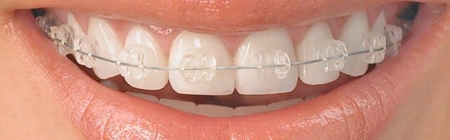 ortodoncia en alcala 2