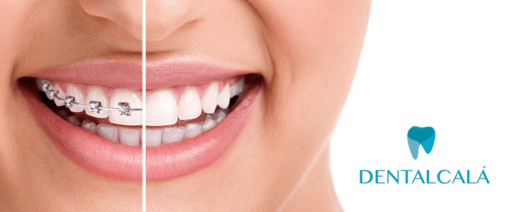 Tratamiento en ortodoncia Dentalcalá